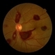 Ocular Manifestation of Acute Leukemia Ocular Manifestation of Acute Leukemia